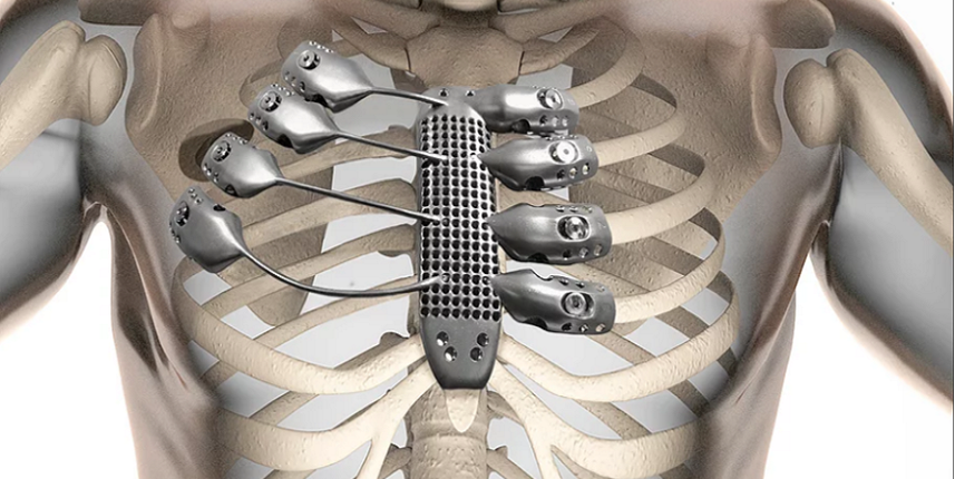 Are There Complications with Titanium Plates Later in Life?